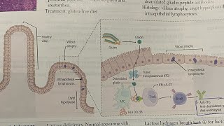 Malabsorption syndrome Celiac  whipple  Hindi neetpg inicet neetpgprep firstaidusmle [upl. by Bergess]