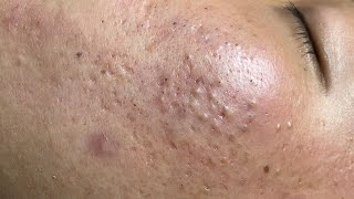 ACNE TREATMENT VU QUYNH MI  Blackheads On Boy Face 2024FULL [upl. by Ahsemat]