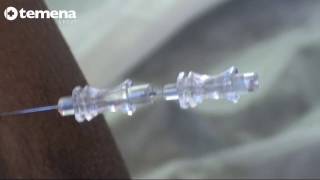 Spinal Anaesthesia with MicroTip® needle Part 22 [upl. by Liagabba71]