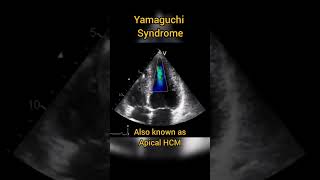 Apical Hypertrophic Cardiomyopathy HCM or Yamaguchi syndrome echocardiography [upl. by Aldarcy397]