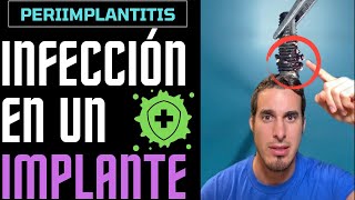 Si llevas IMPLANTES DENTALES esto te interesará  INFECCIÓN DE IMPLANTE o PERIIMPLANTITIS [upl. by Naval]