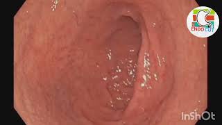 Candida oesophagitis l l Endo Cut [upl. by Odrarej]