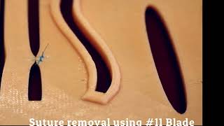 Suture Removal Using 11 scalpel [upl. by Auqenaj]