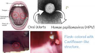 Oral Papilloma  Symptoms causes treatment [upl. by Raman785]