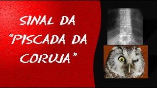 Aula  videoaula e dicas sobre RADIOLOGIA  Radiografia da coluna  Metástase vertebral [upl. by Torey]