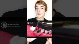 Implant dentaire 🤯 sante dent medecine dentiste [upl. by Latsyrhk]