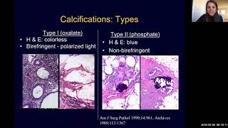 Breast Imaging Calcifications  module 1  Health4TheWorld Academy [upl. by Sirred]