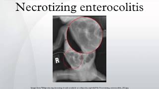 Necrotizing enterocolitis [upl. by Otsugua]