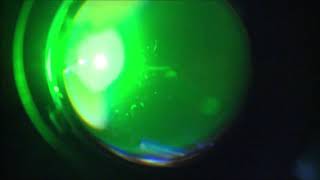 Proliferatif diabetik retinopatili bir olguda argon laser fotokoagülasyon tedavisi [upl. by Laehcym]