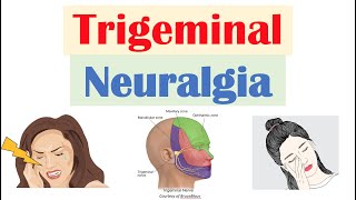 Trigeminal Neuralgia “Severe Facial Pain” Causes Pathophysiology Symptoms Diagnosis Treatment [upl. by Choong]