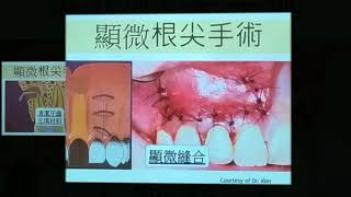 顯微根尖手術 牙齒保留的最後一線生機 [upl. by Raney]