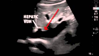 IVC Ultrasound [upl. by Adnahcir]