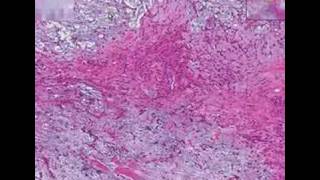 Histopathology Salivary glandPleomorphic adenoma mixed tu [upl. by Fausta]