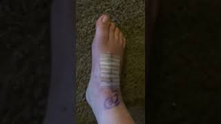 Day 20 after midfoot fusion amp bone graft for lisfranc dislocation [upl. by Nilla]