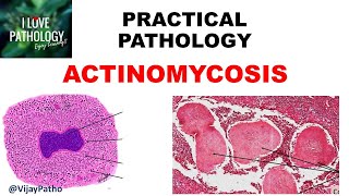 Practical Pathology ACTINOMYCOSIS [upl. by Kenison599]