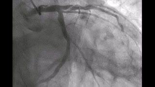 Treatment of a Left Main Dissection [upl. by Yancey]