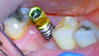 🦷 Full DENTAL IMPLANT PROCEDURE Before and After  Extraction Surgery amp Crown On Back Tooth Molar [upl. by Moorish]