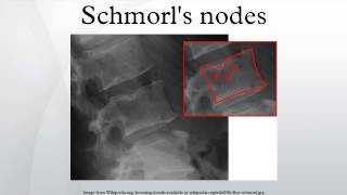 Schmorls nodes [upl. by Ylnevaeh]