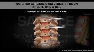 Anterior Cervical Discectomy amp Fusion at C34 C45 amp C56 [upl. by Yngiram]