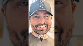 I Tried The BEST Dental Veneers Available Online [upl. by Celinda716]