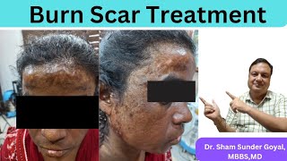 Odisa Burn Scar Client  Combination Treatment  Hypertrophic Scars  Pinholex  Kayalkalp Laser [upl. by Illehs190]