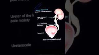 QUICK WEIGERT MEYER RULE UROLOGYRENAL SURGERY FINAL YEAR MBBS [upl. by Alphonso567]