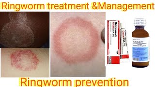 Ringworm treatment and management Ringworm prevention Antifungal cream and powdersmedicalschool [upl. by Adnolohs]