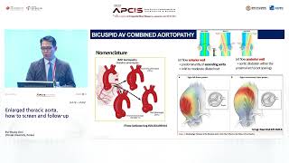 Enlarged thoracic aorta how to screen and followup [upl. by Gemina843]