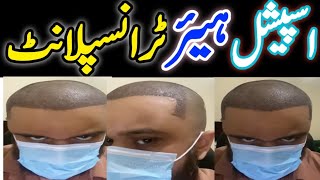 Special Hair Transplant in Pakistan [upl. by Eilac]