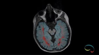 icometrix brain segmentation  scrolling through the MRI of an MS patient [upl. by Graeme]