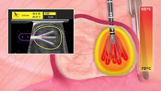 Acessa Procedure Quick Overview Animation [upl. by Ayortal]