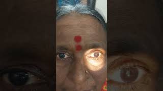 RAPD Relative Afferent Pupilary Defect in left eye [upl. by Rai]