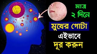 মাত্র ২ দিনে মুখের ব্রণ দূর করার টিপস  How to Remove Your Facial Pimples Without Investing Money [upl. by Suzann]