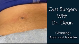 Cyst removal with Dr Dean [upl. by Kilbride]