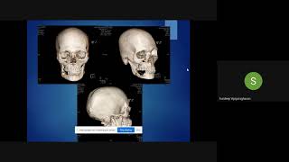 Plastiquest Case DiscussionAmeloblastoma Mandible 1 [upl. by Novoj812]