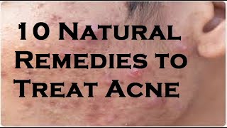 10 Natural Remedies to Treat Acne [upl. by Alfeus]