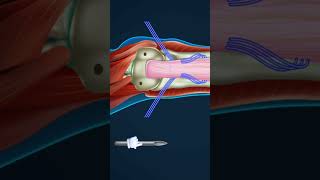 muscle tissue breakdown [upl. by Yehudit]