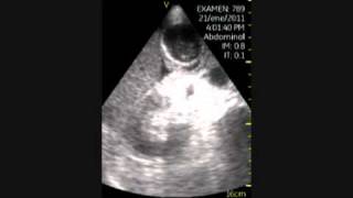 VSCAN Cholecystitis pocket ultrasound Colecistitis aguda eco de bolsillo [upl. by Eecats531]