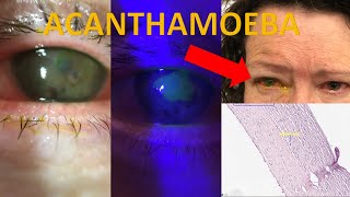 Acanthamoeba keratitis Severe case diagnosis investigation management Evidencebased series [upl. by Neely]