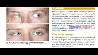 Kanski Clinical Ophthalmology Made Easy  Strabismus 8 [upl. by Jillane110]