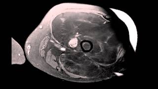 Well differentiated Liposarcoma Left Thigh [upl. by Oria]