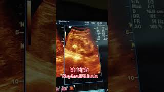 Multiple nephrolithiasis ultrasound showing video  kidney stones ultrasound ultrasound pregnant [upl. by Serolod438]