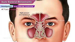 Acute Bacterial Rhinosinusitis ABRS  ENT Lectures [upl. by Nylynnej]