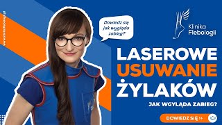 Laserowe usuwanie żylaków  jak wygląda zabieg [upl. by Nyltiac]