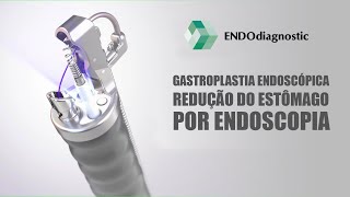 GASTROPLASTIA REDUTORA [upl. by Hildegard]