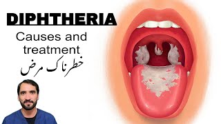 Diphtheria  Symptoms Causes and treatment [upl. by Reddin]