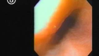 TOP 14 Part 1 Flexible Endoscopy [upl. by Aneral]