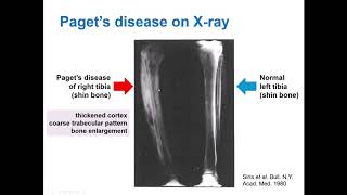 What is Paget’s Disease of Bone and how does bisphosphonate treatment work Dr Daroszewska explains [upl. by Akaenahs]