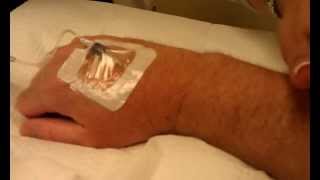 IVIG Infusion Procedure part 2  Treatment for Stiff Person Syndrome [upl. by Iggep]