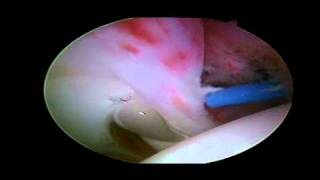 Labral Tear  Detached Anterior Labrum [upl. by Ysus290]